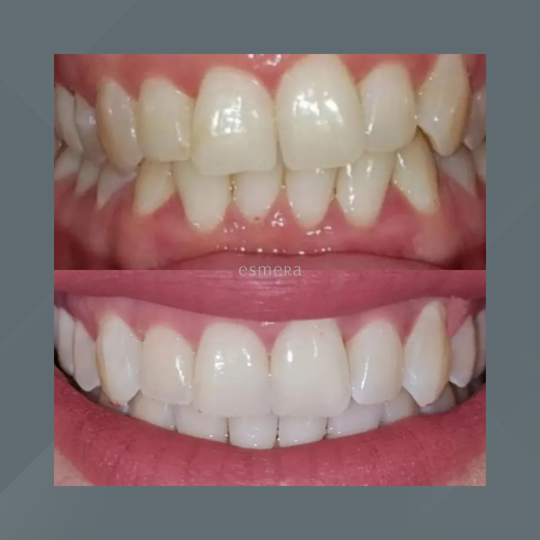 Esmera Clínica Odontológica. Clareamento Dental #1.1