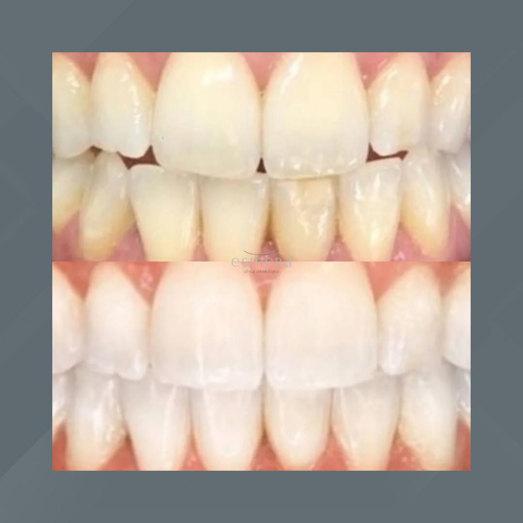 Esmera Clínica Odontológica. Clareamento Dental #2.1