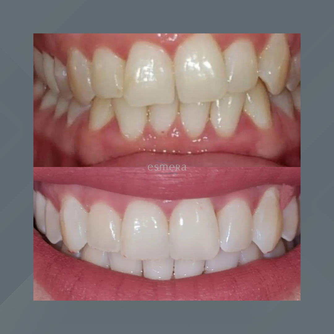 Esmera Clínica Odontológica. Clareamento Dental #3.1