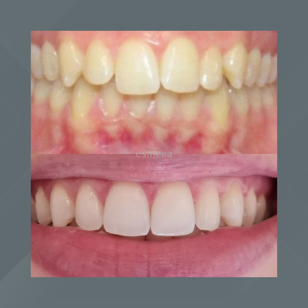 Esmera Clínica Odontológica. Clareamento Dental #4.1