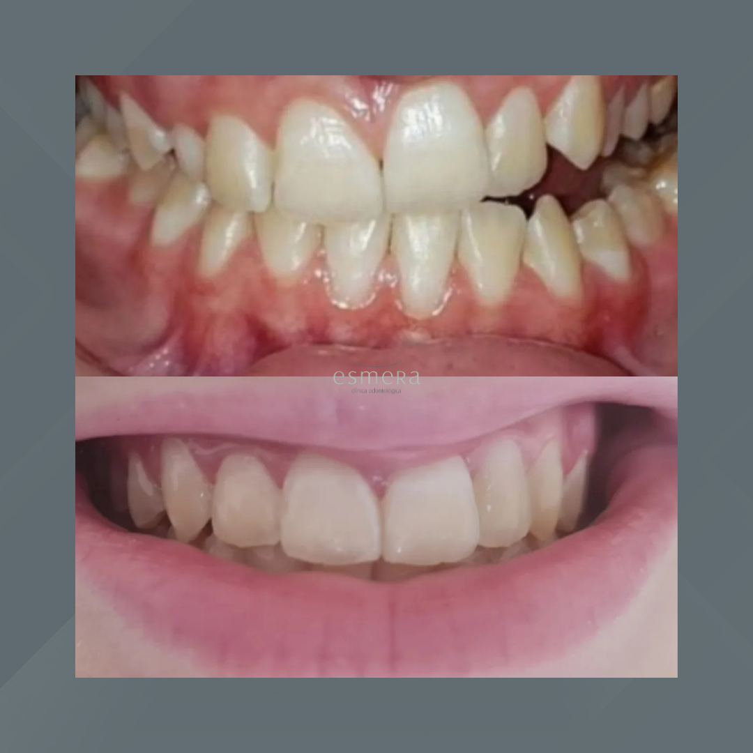 Esmera Clínica Odontológica. Invisalign #1.1