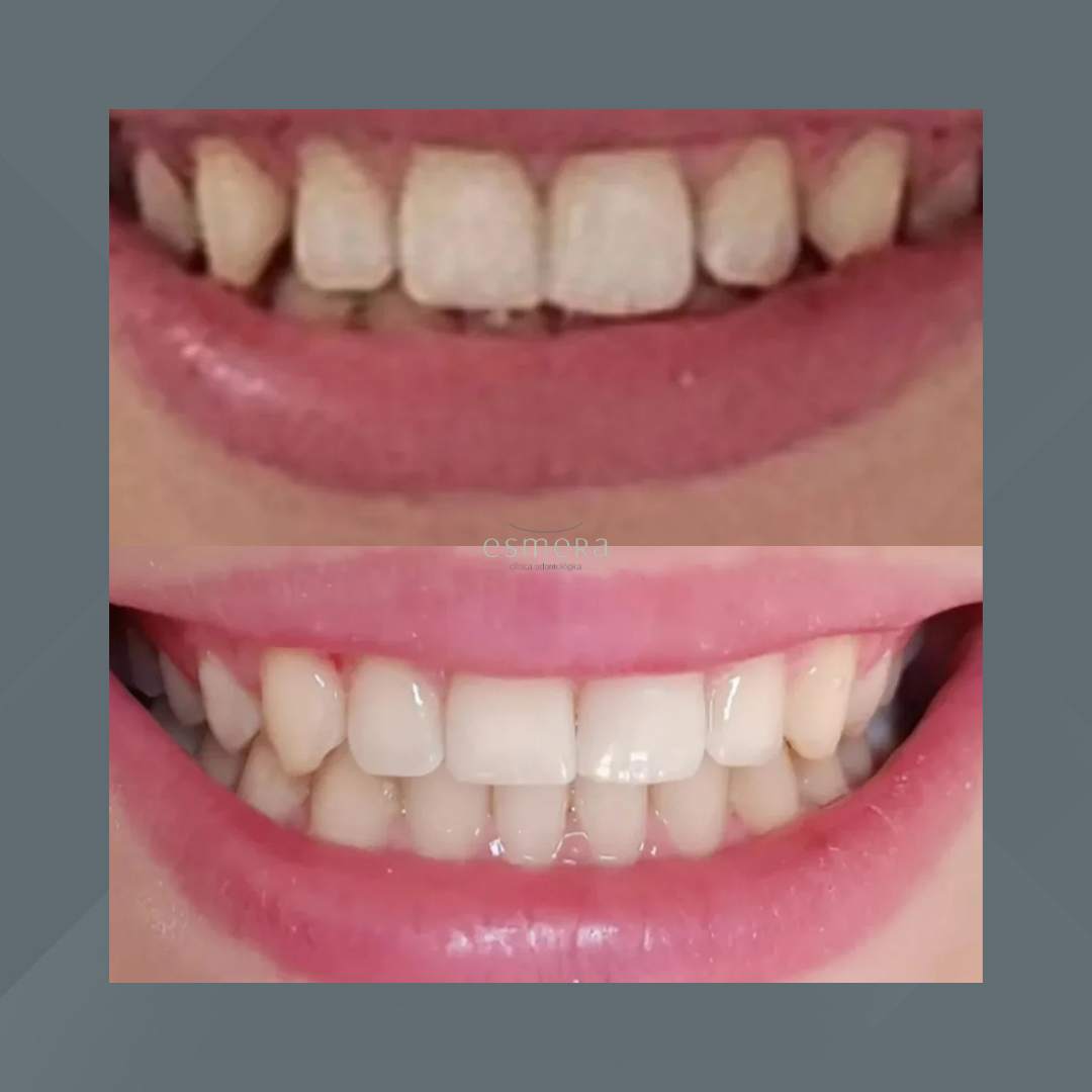 Esmera Clínica Odontológica. Invisalign #2.1