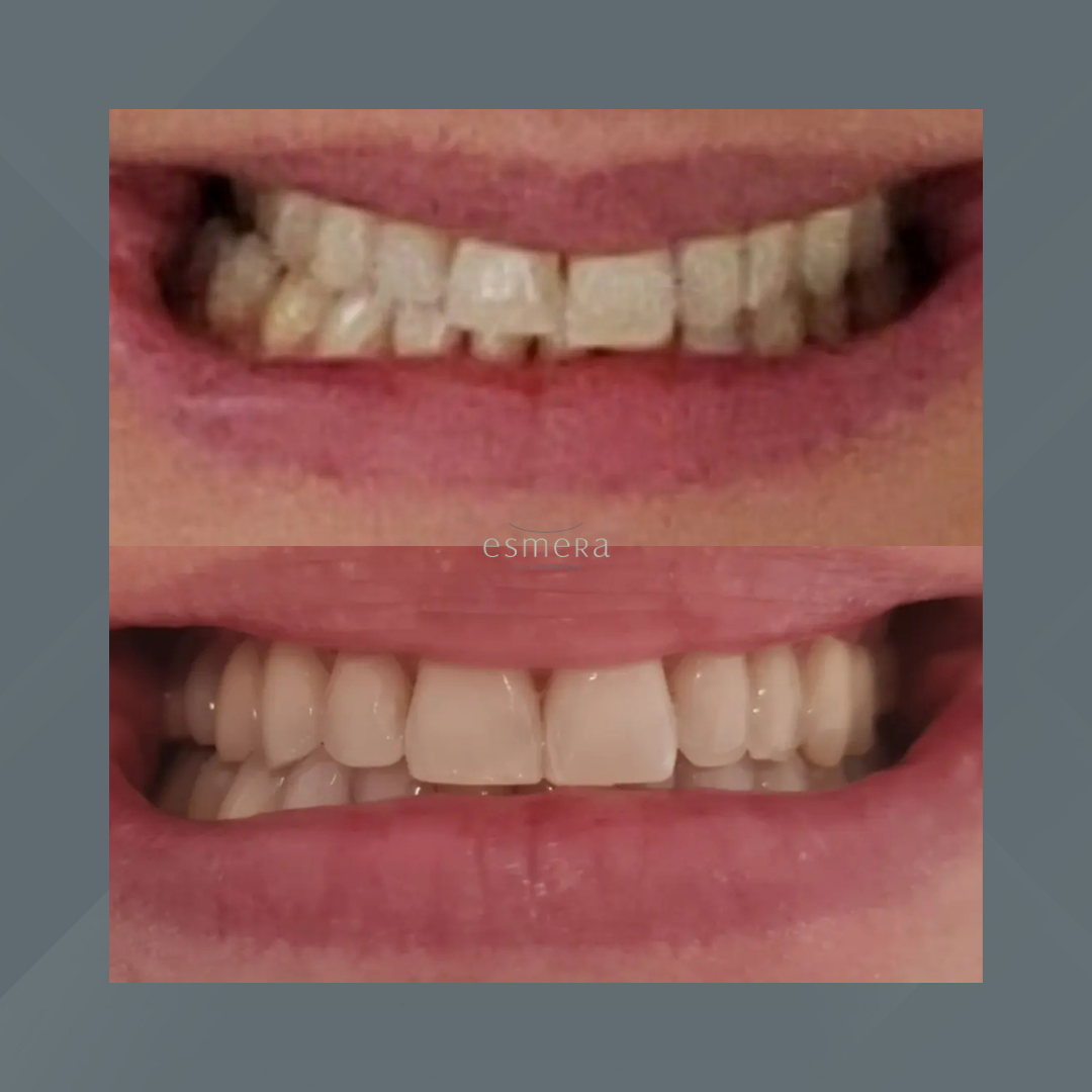 Esmera Clínica Odontológica. Invisalign #3.1
