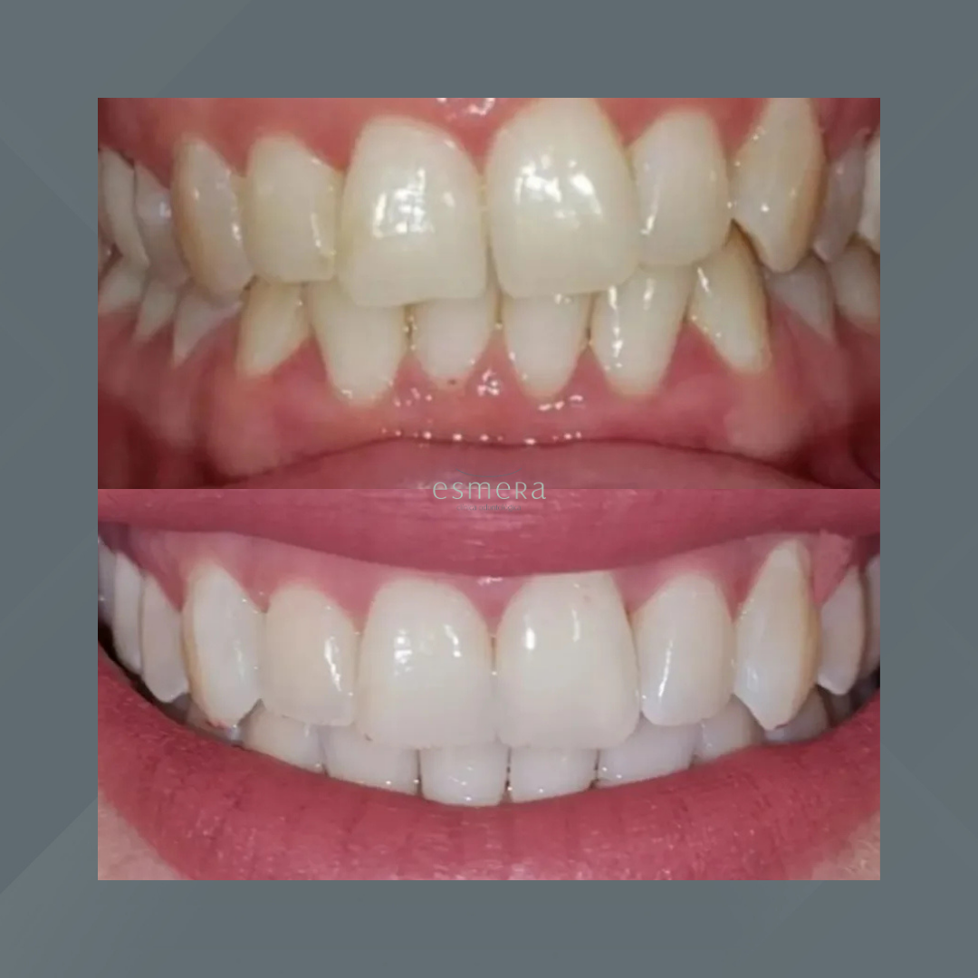 Esmera Clínica Odontológica. Invisalign #4.1