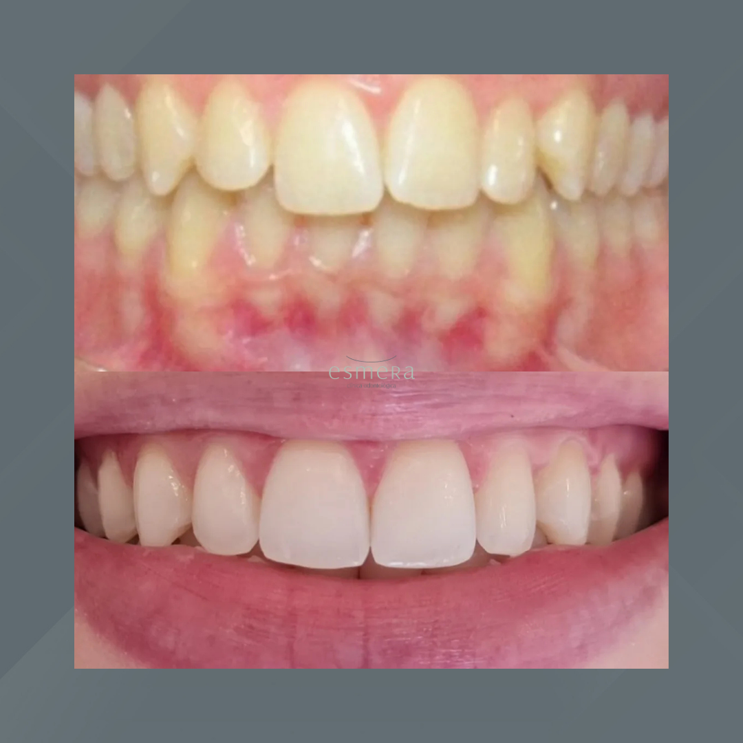 Esmera Clínica Odontológica. Invisalign #5.1