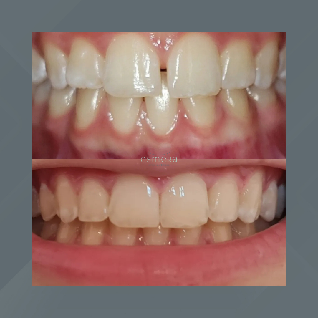 Esmera Clínica Odontológica. Invisalign #6.1