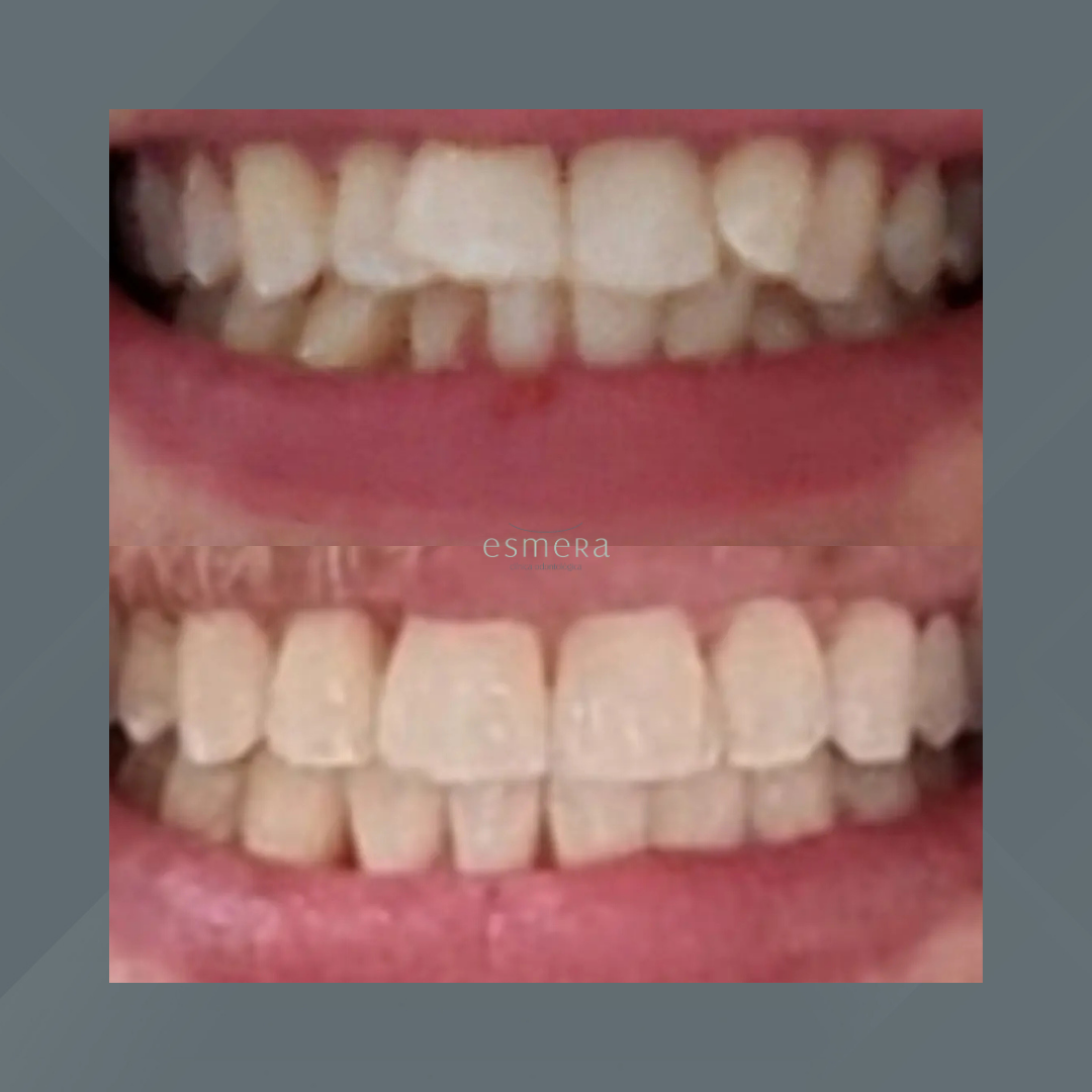 Esmera Clínica Odontológica. Invisalign #7.1