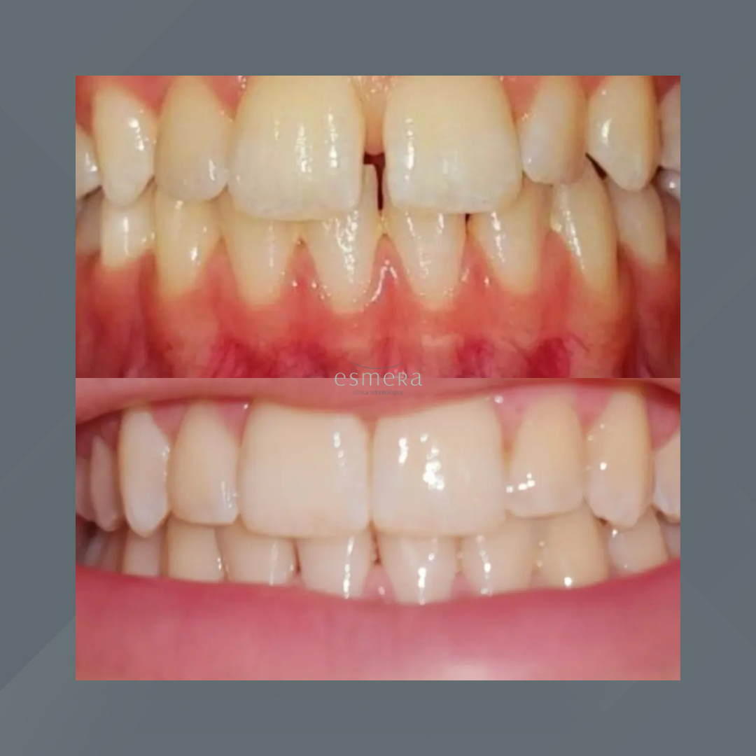 Esmera Clínica Odontológica. Invisalign #8.1